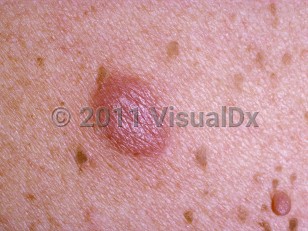 Clinical image of Pseudolymphoma - imageId=209984. Click to open in gallery.  caption: 'A close-up of a reddish nodule that was rubbery on palpation (with surrounding tiny seborrheic keratoses and a pink pedunculated nevus).'
