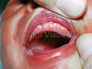 Clinical image of Palatal and gingival cyst of newborn - imageId=2110243. Click to open in gallery.  caption: 'Whitish papules of the upper gingiva.'