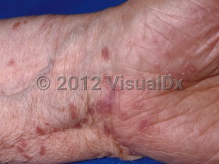 Clinical image of Lichen planus - imageId=21134. Click to open in gallery.  caption: 'Flat-topped violaceous, polygonal papules, some annular, with fine white scale at the wrist.'