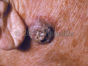 Clinical image of Keratoacanthoma - imageId=213569. Click to open in gallery.  caption: 'A close-up of a violaceous nodule with a central keratotic core.'