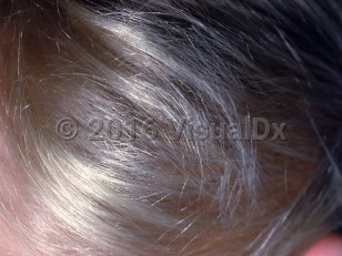 Clinical image of Bjornstad syndrome - imageId=2149596. Click to open in gallery.  caption: 'Spangled scalp hair.'