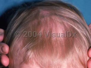 Clinical image of Telogen effluvium - imageId=2152005. Click to open in gallery.  caption: 'Diffuse nonscarring thinning of scalp hair.'