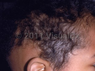 Clinical image of Radiation-induced alopecia - imageId=2152190. Click to open in gallery.  caption: 'A broad alopecic patch at the occipital scalp and patchy alopecia on the temporal scalp following radiation.'