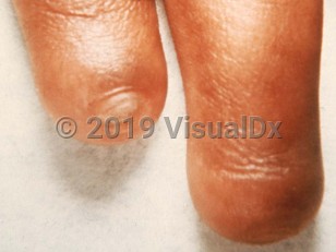 Clinical image of Congenital anonychia - imageId=2158435. Click to open in gallery.  caption: 'Absent fingernails.'