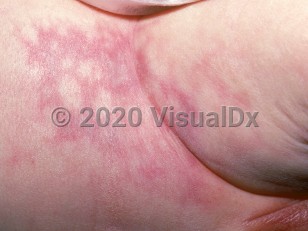 Clinical image of Umbilical catheter misplacement injury - imageId=2163455. Click to open in gallery.  caption: 'Retiform violaceous patches and plaques on the abdomen and thigh.'