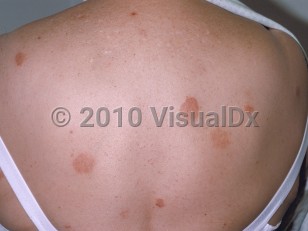 Clinical image of Nummular dermatitis - imageId=216877. Click to open in gallery.  caption: 'Discrete, round, light red and brown plaques on the back.'