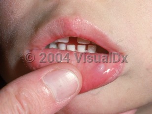 Clinical image of Oral mucocele - imageId=2177024. Click to open in gallery.  caption: 'A smooth gray-white papule on the lower labial mucosa.'