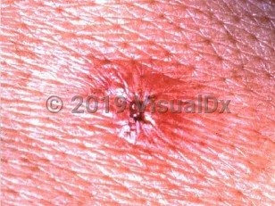 Clinical image of Japanese spotted fever - imageId=2183681. Click to open in gallery.  caption: 'A close-up of an erythematous papule with a central hemorrhagic crust.'