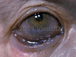 Clinical image of Argyria - imageId=2193996. Click to open in gallery.  caption: 'Blue-gray discoloration of the sclera and periorbital skin after use of a topical silver-containing antiseptic.'