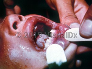 Clinical image of Endemic syphilis - imageId=2200140. Click to open in gallery. 