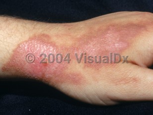 Clinical image of Fire coral sting - imageId=2201820. Click to open in gallery. 