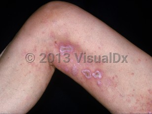 Clinical image of Drug-induced skin ulcers - imageId=2202445. Click to open in gallery. 
