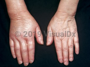 Clinical image of Buerger disease - imageId=2221719. Click to open in gallery. 