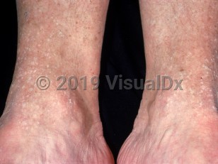 Clinical image of Acrokeratosis verruciformis - imageId=2225855. Click to open in gallery.  caption: 'Numerous discrete, hypopigmented, scaly papules around the ankles.'
