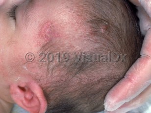 Clinical image of DiGeorge syndrome - imageId=2227747. Click to open in gallery. 