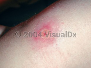 Clinical image of Tanapox - imageId=2237387. Click to open in gallery.  caption: 'A crusted pink and purpuric plaque on the upper arm.'