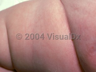 Clinical image of Focal dermal hypoplasia - imageId=2240988. Click to open in gallery.  caption: 'White atrophic papules and plaques on the buttock and posterior thigh.'