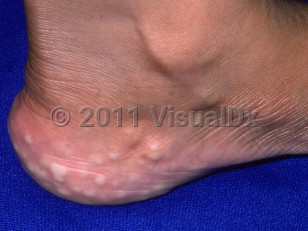 Clinical image of Piezogenic papules - imageId=2299302. Click to open in gallery.  caption: 'Numerous whitish papules around the heel.'