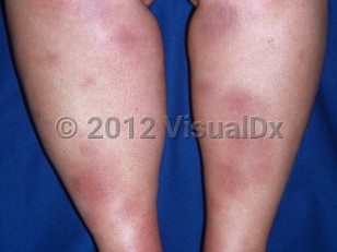 Clinical image of Erythema nodosum - imageId=2299356. Click to open in gallery.  caption: 'Many erythematous and ecchymotic plaques of varying sizes on the lower legs.'