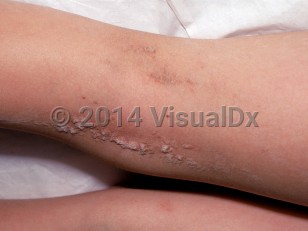 Clinical image of Keratinocytic epidermal nevus - imageId=2307735. Click to open in gallery.  caption: 'Scaly, verrucous papules and plaques following Blaschko lines on the leg.'