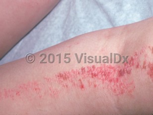 Clinical image of Inflammatory linear verrucous epidermal nevus - imageId=2308799. Click to open in gallery.  caption: 'A linear array of flat, pink and reddish, scaly papules and plaques on and around the popliteal fossa.'
