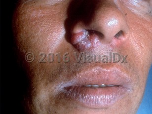 Clinical image of Rhinoscleroma - imageId=232127. Click to open in gallery.  caption: 'Confluent reddish papules forming a plaque at the inferior nostril.'