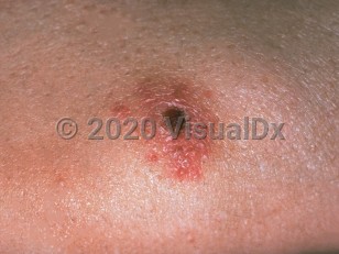 Clinical image of Tularemia - imageId=233146. Click to open in gallery.  caption: 'A close-up of an erythematous plaque with a central early eschar.'