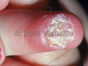 Clinical image of Nail candidiasis - imageId=2350574. Click to open in gallery. 