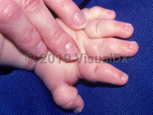 Clinical image of Turner syndrome - imageId=2353699. Click to open in gallery.  caption: 'Prominent edema of the hand and fingers.'