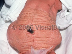 Clinical image of Prune belly syndrome - imageId=2362444. Click to open in gallery.  caption: 'A protruding abdomen with furrowing and wrinkling.'
