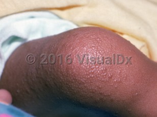 Clinical image of Cardiofaciocutaneous syndrome - imageId=2362688. Click to open in gallery.  caption: 'Scaly, follicular-based, skin-colored, and light brown papules on the knee.'