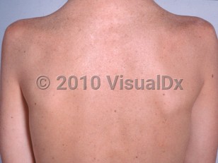 Clinical image of Cockayne syndrome - imageId=2364303. Click to open in gallery. 