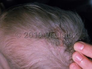 Clinical image of Hyperimmunoglobulinemia E syndrome - imageId=2367277. Click to open in gallery.  caption: 'A weeping and crusted plaque on the scalp.'