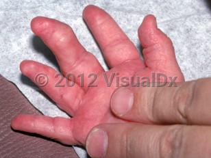 Clinical image of Proteus syndrome - imageId=2369560. Click to open in gallery. 