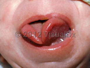 Clinical image of Beckwith-Wiedemann syndrome - imageId=2377060. Click to open in gallery. 