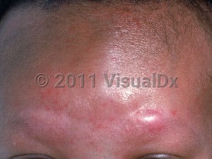Clinical image of Congenital leukemia - imageId=2388686. Click to open in gallery.  caption: 'A shiny pink nodule over the eyebrow and unrelated papules of neonatal acne on the lower forehead.'