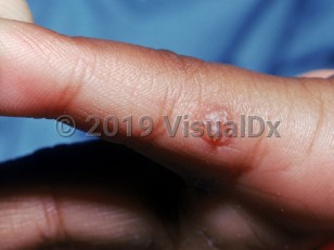 Clinical image of Traumatic neuroma - imageId=2423321. Click to open in gallery.  caption: 'A scaly and crusted, partially avulsed papule on the finger.'