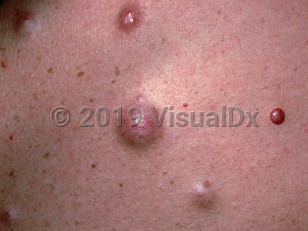 Clinical image of Progressive nodular histiocytoma - imageId=2428911. Click to open in gallery.  caption: 'A close-up of reddish and violaceous papules and nodules.'