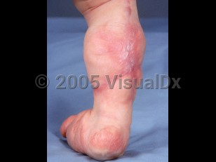Clinical image of Lipoblastomatosis - imageId=2453048. Click to open in gallery. 