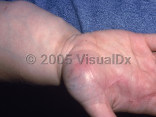 Clinical image of Lipoblastoma - imageId=2453572. Click to open in gallery.  caption: 'A palmar subcutaneous mass with overlying erythema and surgical scars. Note also the increased girth of the forearm.'