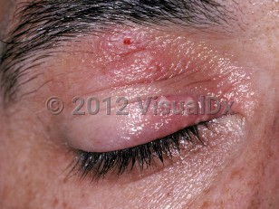 Clinical image of Herpes simplex virus blepharitis - imageId=248988. Click to open in gallery.  caption: 'Grouped pustules on an erythematous base on the upper eyelid.'