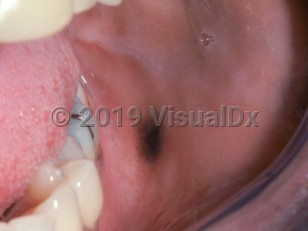 Clinical image of Oral melanoacanthoma - imageId=2490173. Click to open in gallery.  caption: 'A dark brown and blackish macule on the buccal mucosa.'