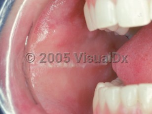 Clinical image of Linea alba - imageId=2491878. Click to open in gallery.  caption: 'A horizontal, linear, white plaque on the buccal mucosa.'