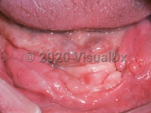 Clinical image of Denture-induced hyperplasia - imageId=2492892. Click to open in gallery.  caption: 'Numerous linear fleshy plaques at the gingival-alveolar mucosa of an edentulous patient.'