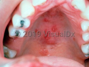 Clinical image of Sjögren syndrome - imageId=2493440. Click to open in gallery.  caption: 'Reddish vascular papules on the palate.'