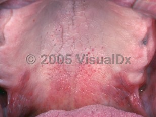 Clinical image of Nicotine stomatitis - imageId=2494383. Click to open in gallery.  caption: 'A diffuse gray-white color of the mucosa and numerous slightly elevated papules with red centers on the palate.'