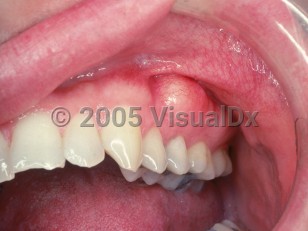 Clinical image of Oral exostoses - imageId=2502078. Click to open in gallery.  caption: 'A smooth papule at the gingiva.'