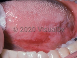 Clinical image of Oral erythroplakia - imageId=2502802. Click to open in gallery.  caption: 'A red and white plaque on the ventral tongue.'