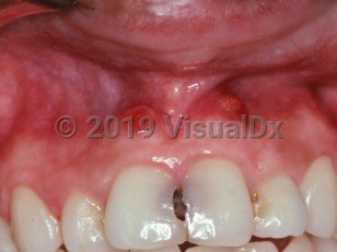 Clinical image of Mucosal dental sinus tract - imageId=2503603. Click to open in gallery.  caption: 'Red papules on the attached mucosa above the marginal gingiva, at the apex of teeth with caries.'