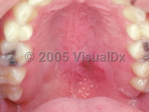Clinical image of Necrotizing sialometaplasia - imageId=2505146. Click to open in gallery.  caption: 'Diffuse palatal swelling and focal erythema.'
